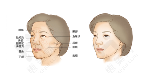 祛斑治疗:个性化方案精细有效