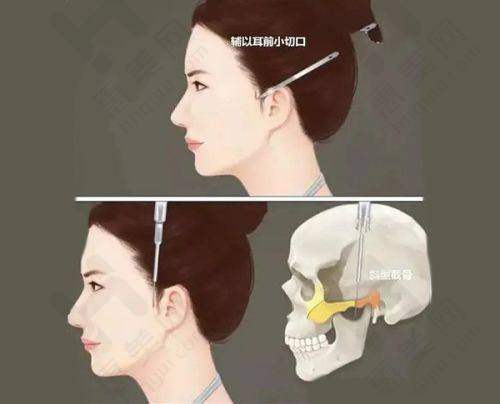 鼻部修复重塑美观鼻型