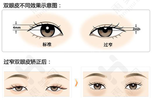 面部拉皮实现年轻化成效