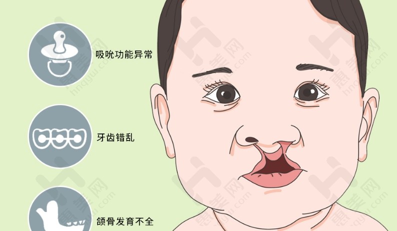 扬州兔唇手术一般多少钱?单侧唇裂修复20000元起,双侧可能更高